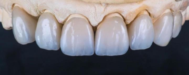 Implant dentaire céramique Castelnau-le-Lez