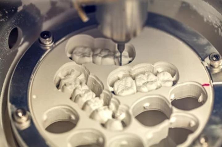 Implant dentaire céramique Castelnau-le-Lez