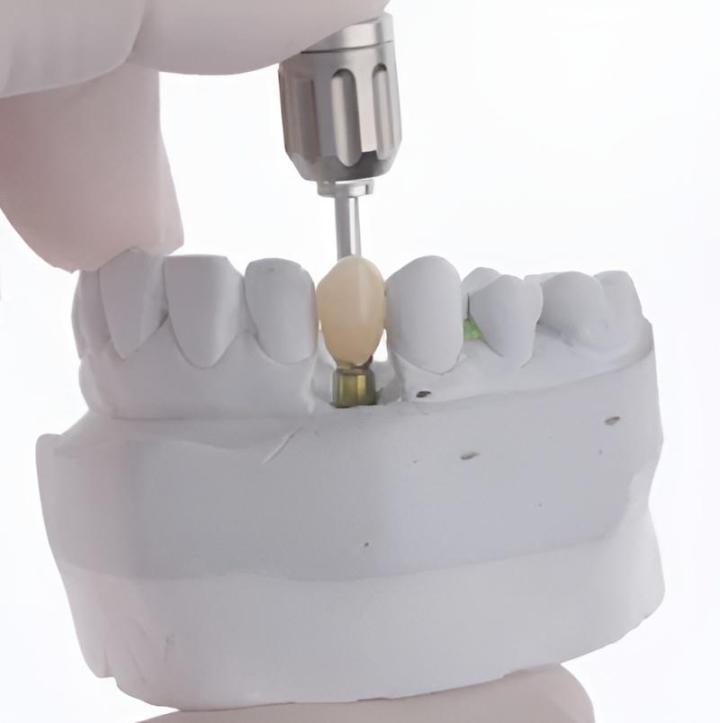 Implant dentaire Castelnau-le-Lez