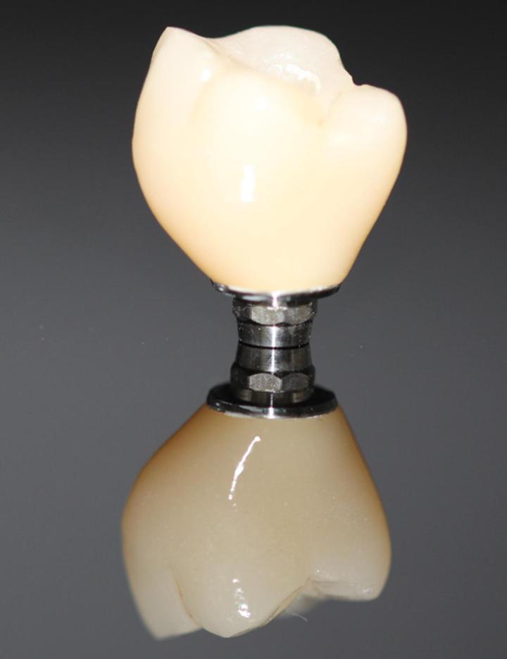 Prothèse dentaireCastelnau-le-Lez