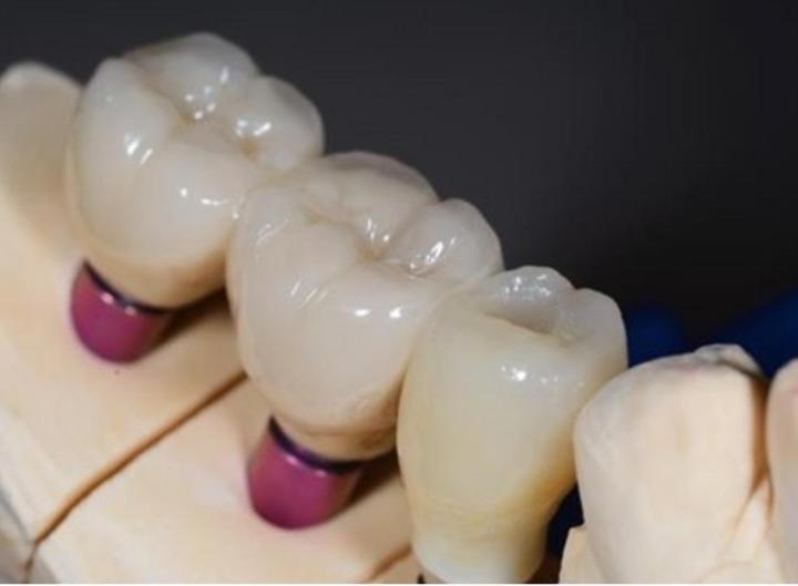 Implantologie Castelnau-le-Lez